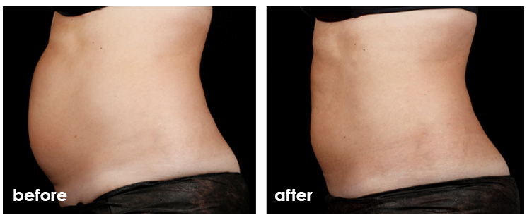 SculpSure before and after — Abdomen · side profile