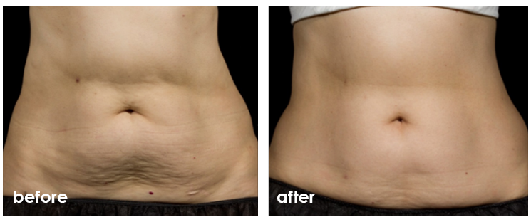 SculpSure before and after — Abdomen · front view