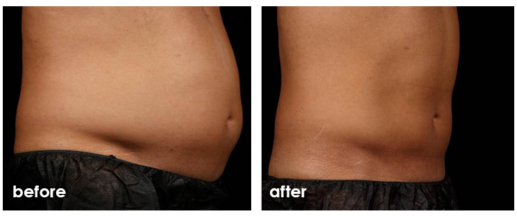SculpSure before and after — Flank & waistline